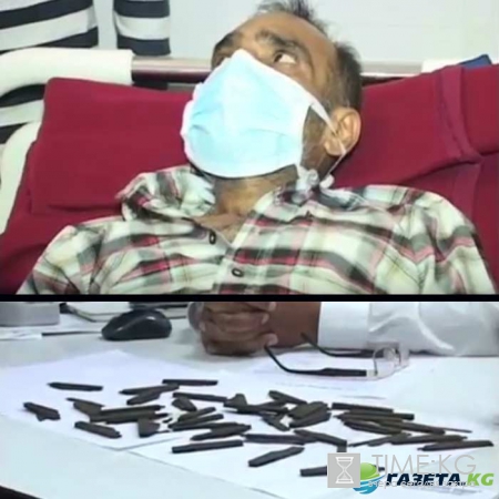 ВИДЕО: индиец проглотил 40 ножей