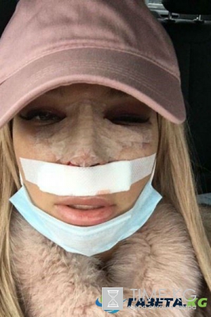 Екатерина Колисниченко сделала ринопластику. ФОТО