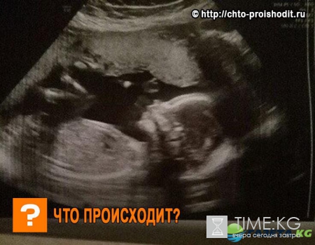Американка с двумя вагинами беременна