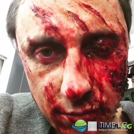 Вадим Галыгин напугал поклонников изуродованным лицом