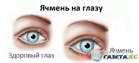Ячмень на глазу: откуда берется и как его лечить