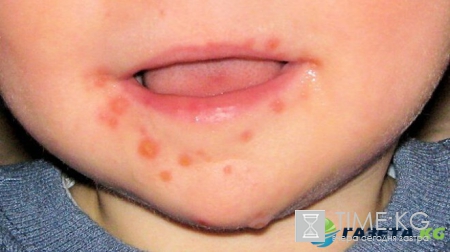 Инфекция в Турции август 2017: есть ли эпидемия, что известно о вирусе Коксаки, фото заболевших детей