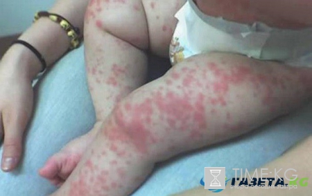 Инфекция в Турции август 2017: есть ли эпидемия, что известно о вирусе Коксаки, фото заболевших детей