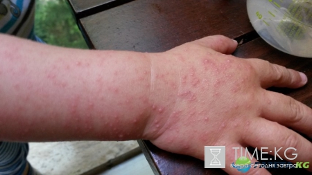 Инфекция в Турции в августе 2017: вирус Коксаки косит туристов, симптомы и лечение болезни, подробности