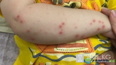 Инфекция в Турции в августе 2017: вирус Коксаки косит туристов, симптомы и лечение болезни, подробности