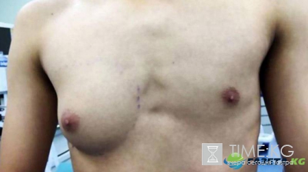 Из-за пристрастия к фаст-фуду у 19-летнего жителя Китая выросла грудь