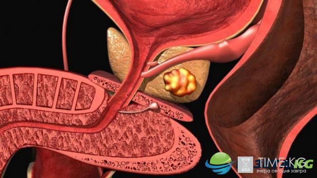 Прорыв в науке на предмет исследования жировых клеток рака предстательной железы